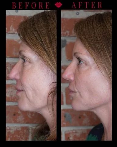 Radiesse - Case 2 before and after at Rewind Aesthetics (3 of 5)