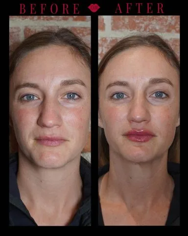 Lip Filler - Case 20 before and after