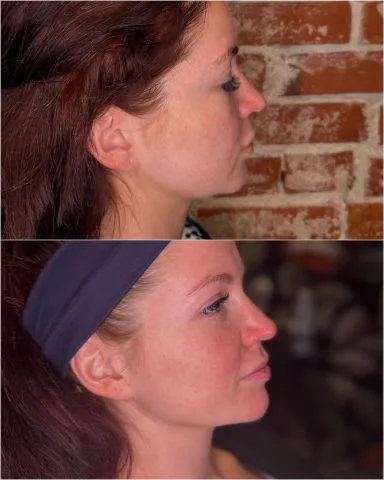 Nefertiti Neck Lift - Case 1 before and after
