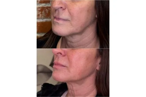 Lip Filler - Case 6 before and after