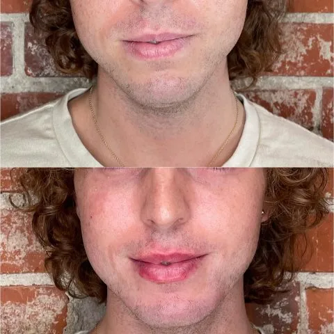 Dermal Fillers - Case 4 before and after at Rewind Aesthetics (3 of 3)