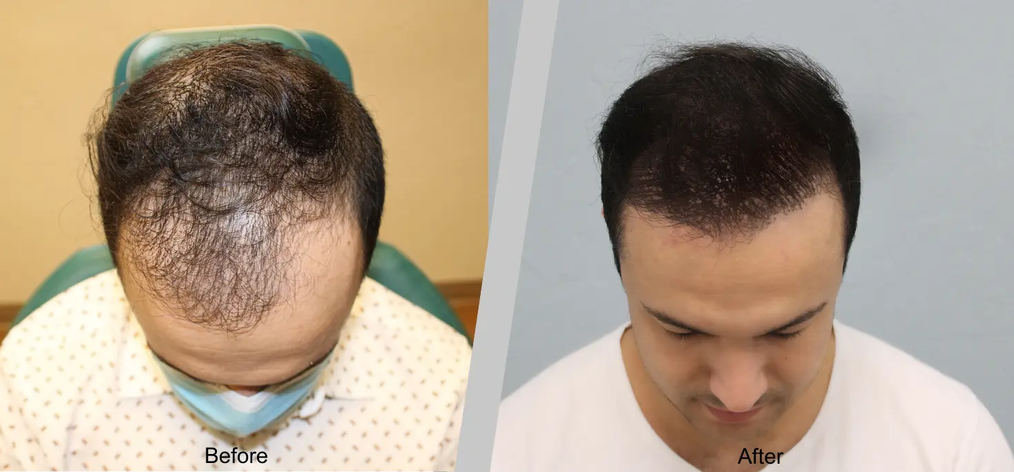 Before (15)