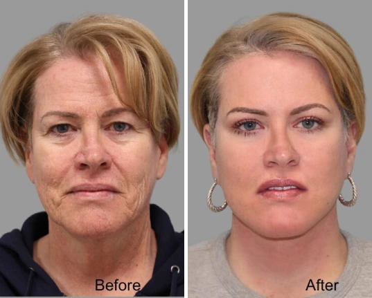 Add-On Treatment: Facelift