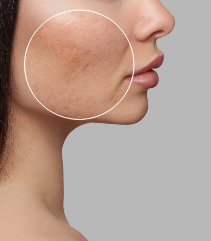 Consultation & Preparation for Laser Resurfacing