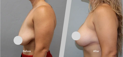 Breast Lift Before and After Banner