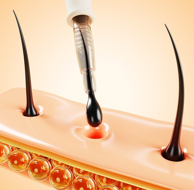 FUE Hair Transplant in Tucson, AZ: What Is a FUE Hair Transplant? Banner