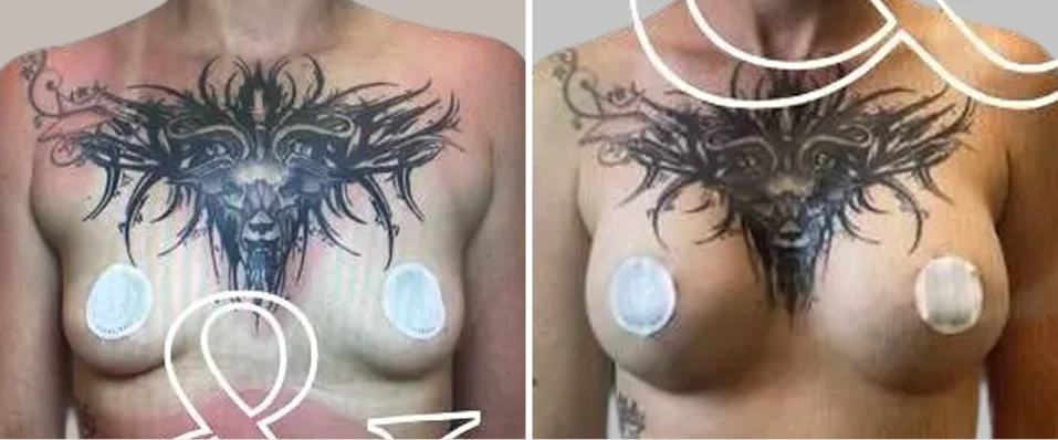 Before and after breast augmentation showing frontal chest view with chest tattoos and implant placement overlay