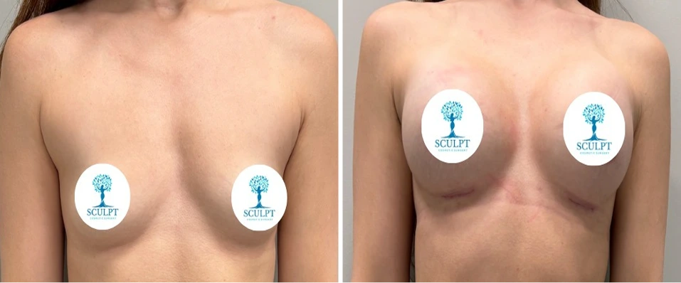 Before and after breast augmentation comparison showing frontal view with SCULPT logo overlay