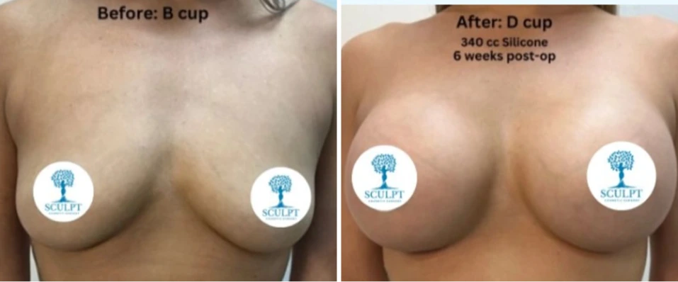 Before and after breast augmentation labeled B cup to D cup 340cc silicone 6 weeks post-op with SCULPT logo overlay