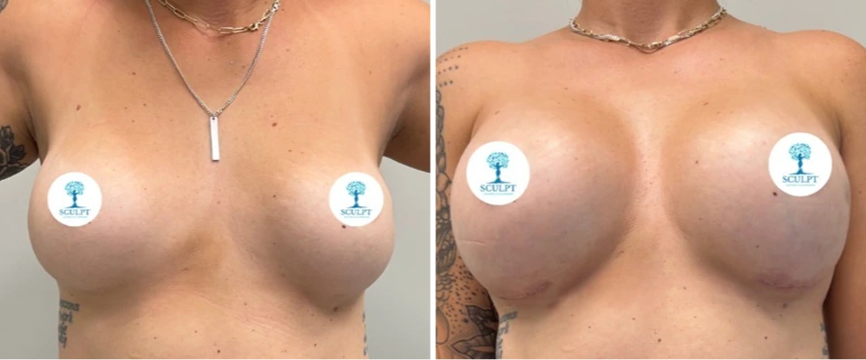 Before and after breast augmentation showing frontal view with patient wearing necklace and SCULPT logo overlay