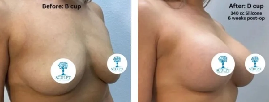 BREAST3