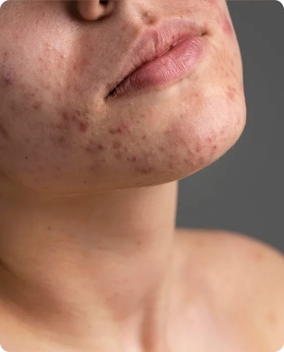 Close-up of person's lower face and neck showing acne breakouts on chin and jawline