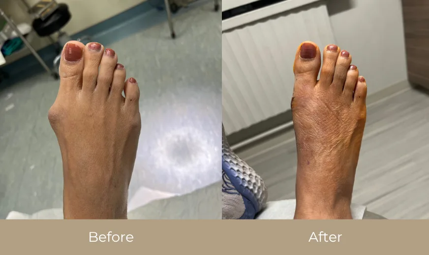 Before and after comparison of swollen foot treated for bunion reduction