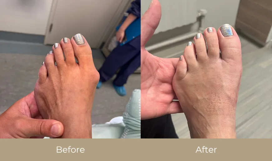 Before and after comparison of foot showing nail treatment results