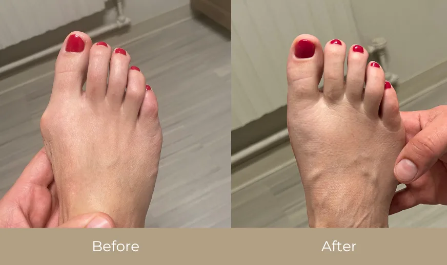 Before and after comparison of foot showing swelling reduction