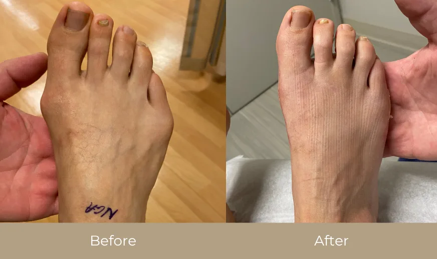 Before and after comparison: foot with bunion and marking on left, reduced bunion on right