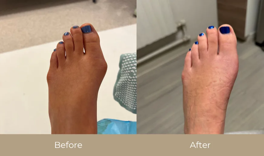 Before and after comparison: swollen foot with blue nail polish on left, reduced swelling on right