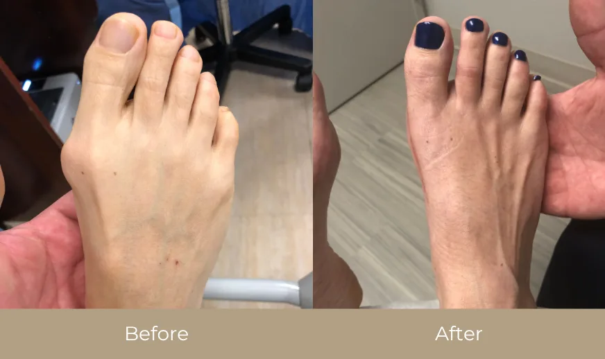 Before and after comparison of foot showing reduced bunion and improved toe positioning