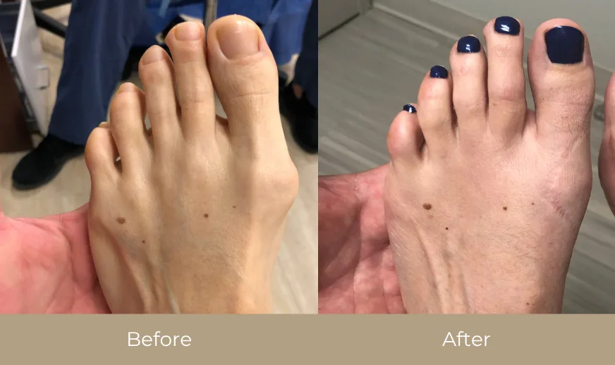 Before and after comparison: foot with bunion and swelling on left, improved alignment on right