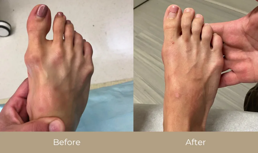 Before and after comparison: foot with bunion and redness on left, improved appearance on right