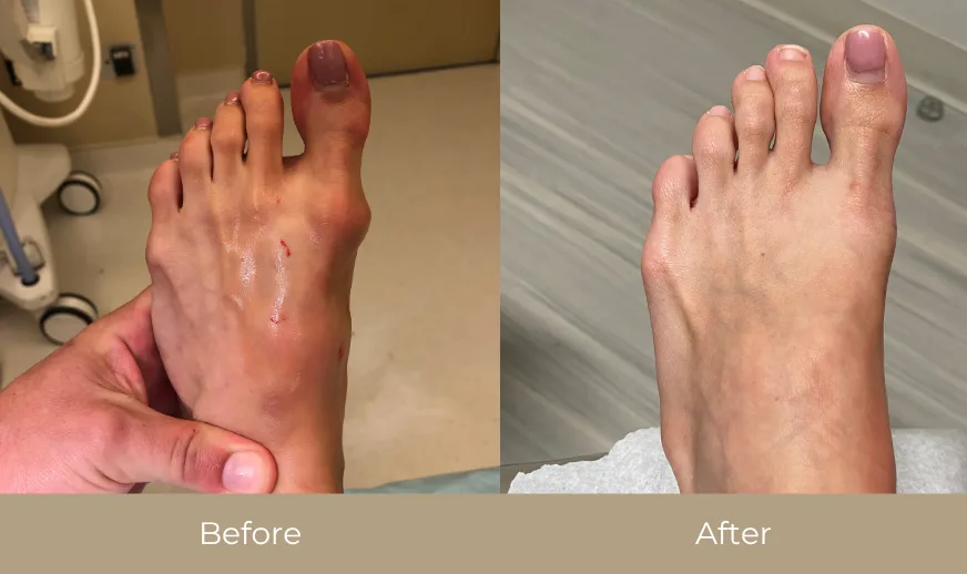 Before and after comparison: foot with bunion and swelling on left, reduced bunion on right
