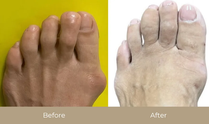 Before and after comparison of bunion treatment showing reduced swelling and improved foot alignment