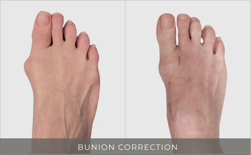 Before and after bunion correction showing swollen foot with bunion on left, reduced swelling on right