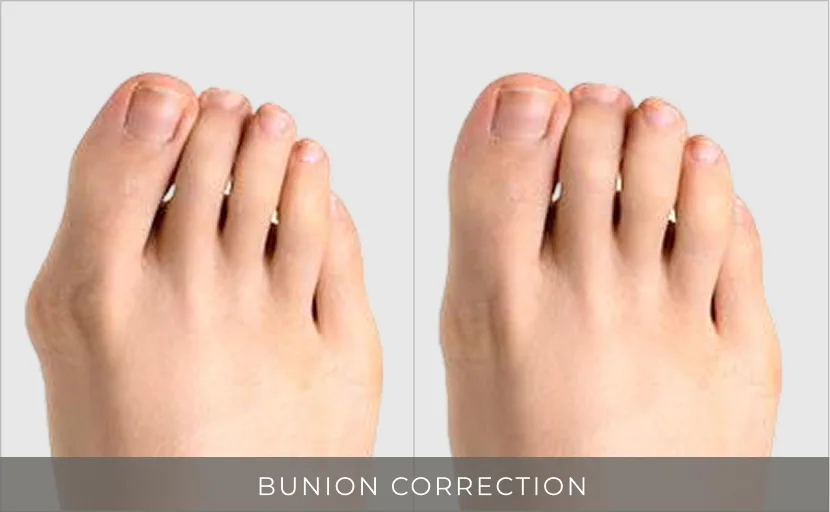 Before and after bunion correction showing foot with prominent bunion on left, aligned foot on right