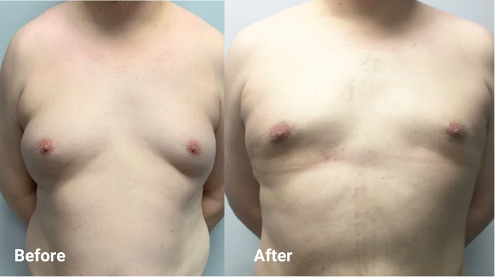 before after 1