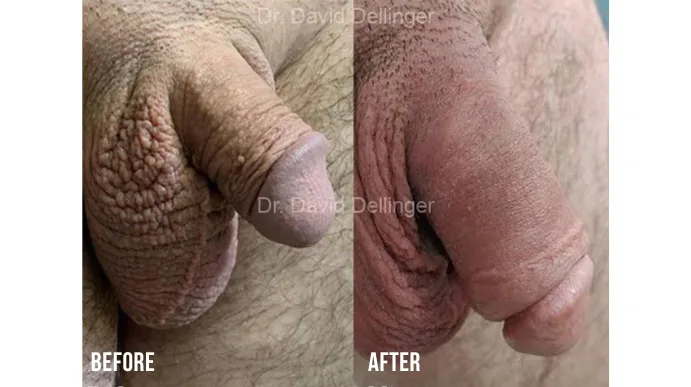 Before and after comparison of penis enlargement procedure results by Dr. David Dellinger