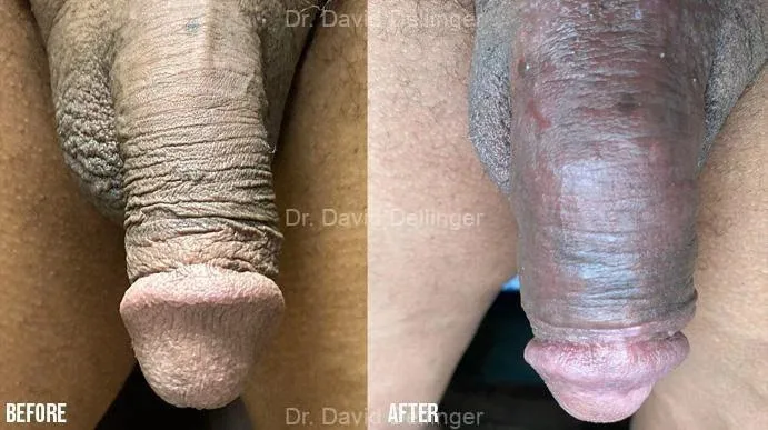 Before and after comparison of penis enlargement results by Dr. David Dellinger