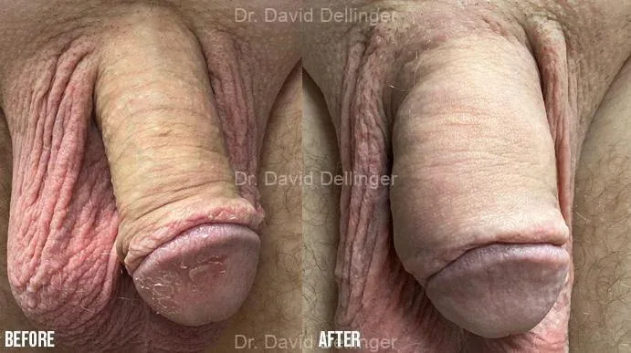 Before and after comparison of penis enlargement results by Dr. David Dellinger