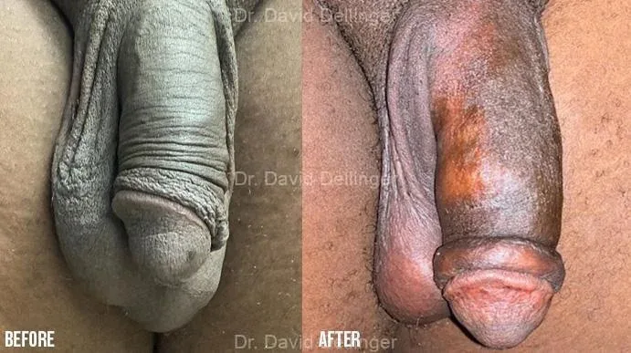 Before and after comparison of penis enlargement results by Dr. David Dellinger
