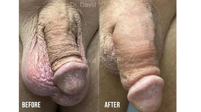 Before and after comparison of penis enlargement results by Dr. David Dellinger