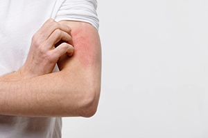 Skin Allergies