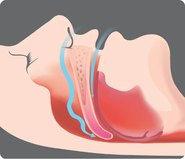 Snoring Relief with Injection Snoreplasty in Houston, TX Banner