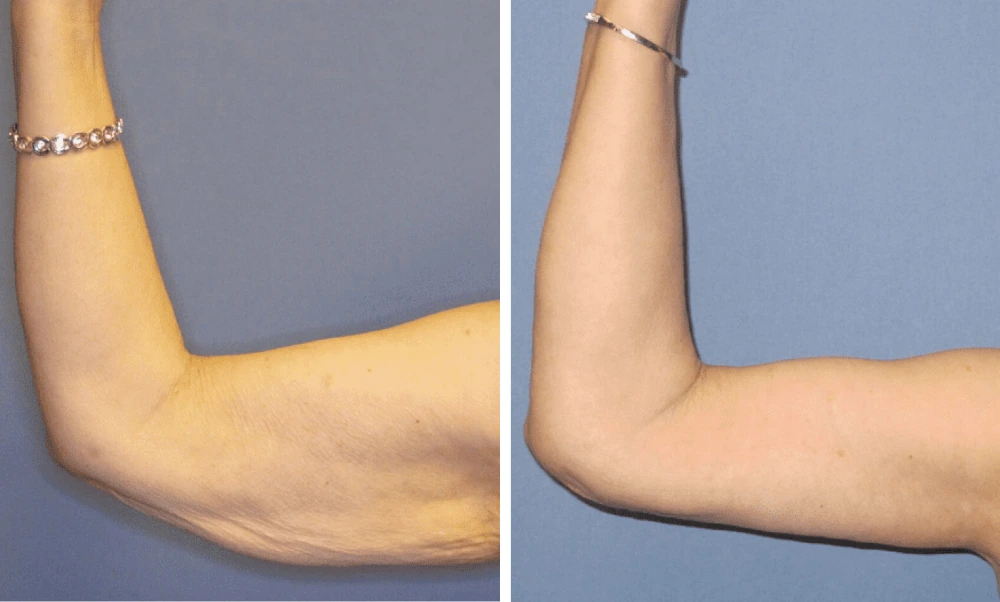 Arm Lift – Case 2