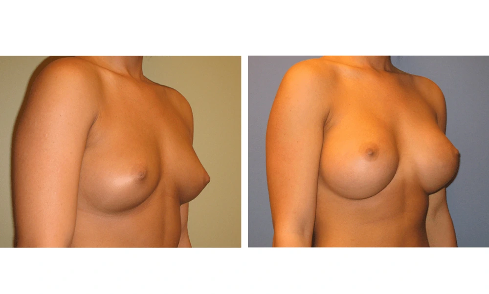 Breast augmentation before and after, side angle view