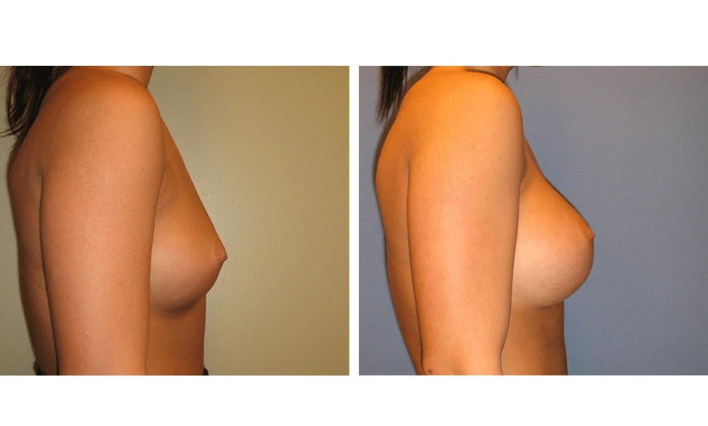 Breast augmentation before and after, side profile view