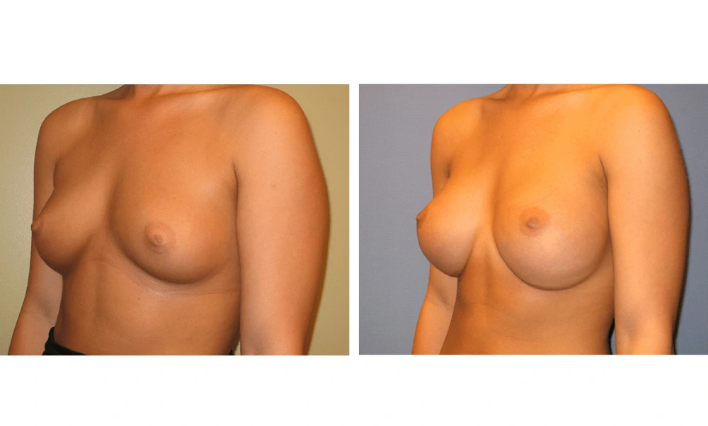 Breast augmentation before and after, three-quarter view