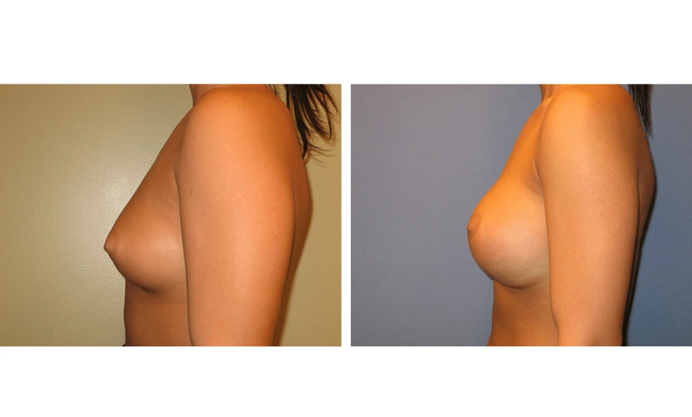Breast augmentation before and after, side profile view
