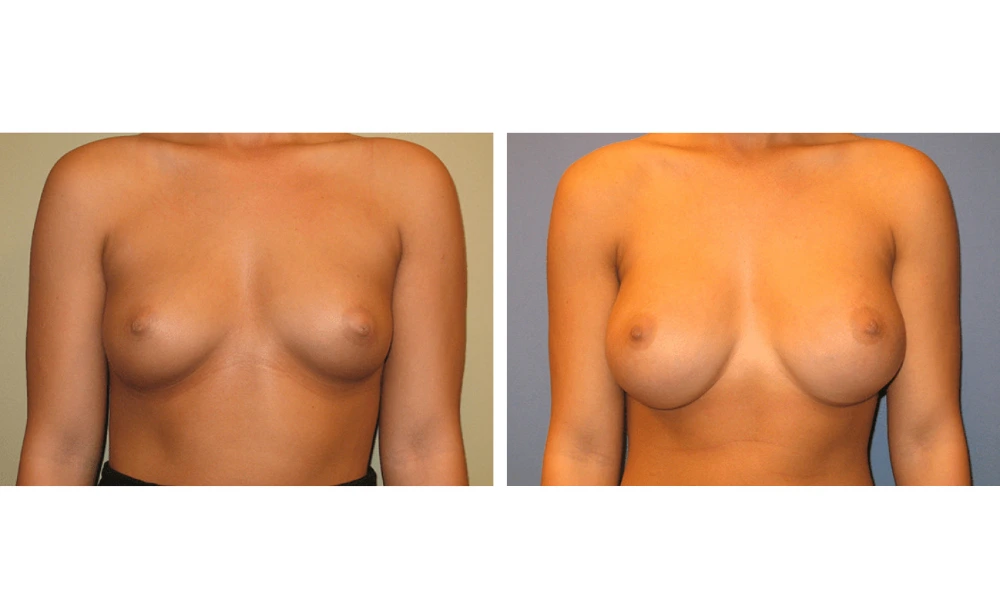 Breast augmentation before and after, frontal view