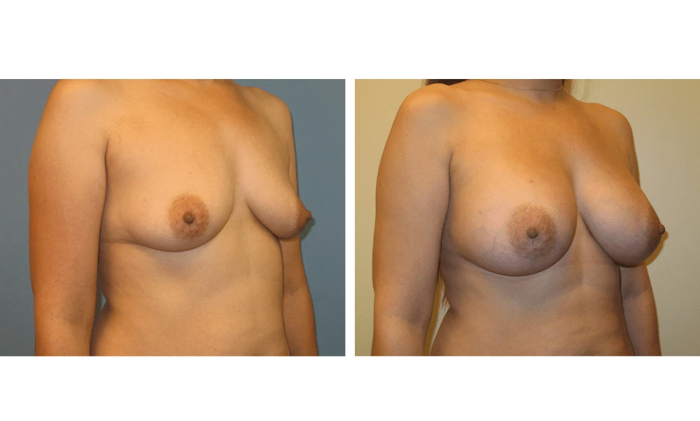 Breast augmentation before and after, frontal view showing increased volume and projection