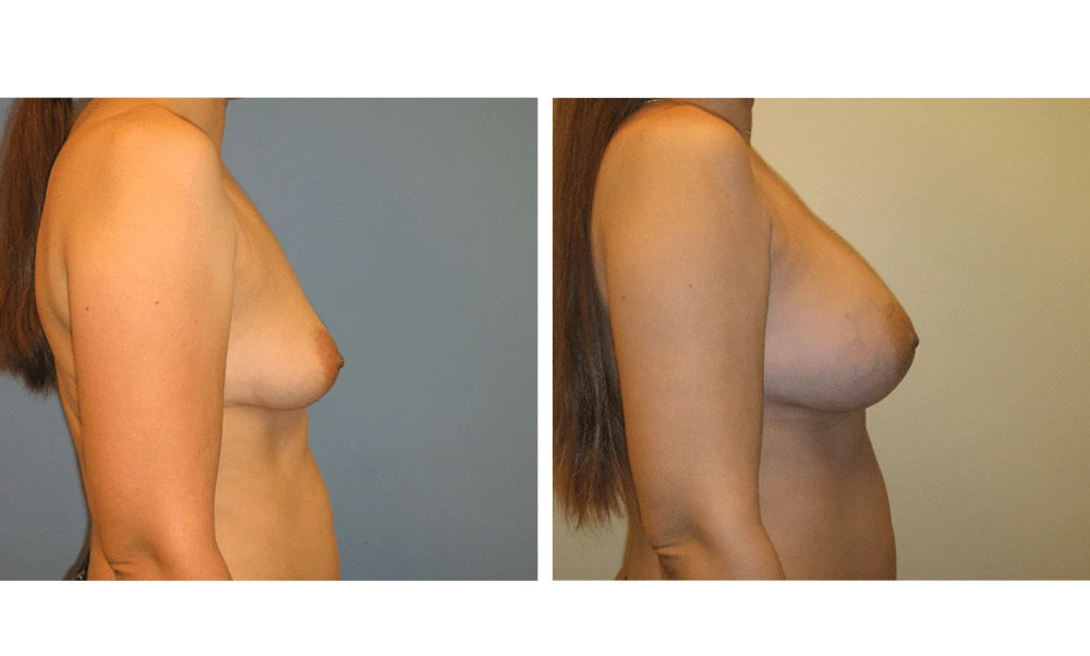 Breast augmentation Case 16 before and after, side view showing improved contour and proportion
