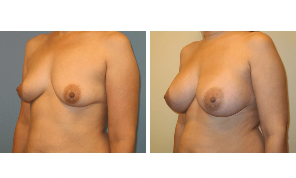 Breast augmentation Case 16 before and after, frontal view displaying symmetry and volume