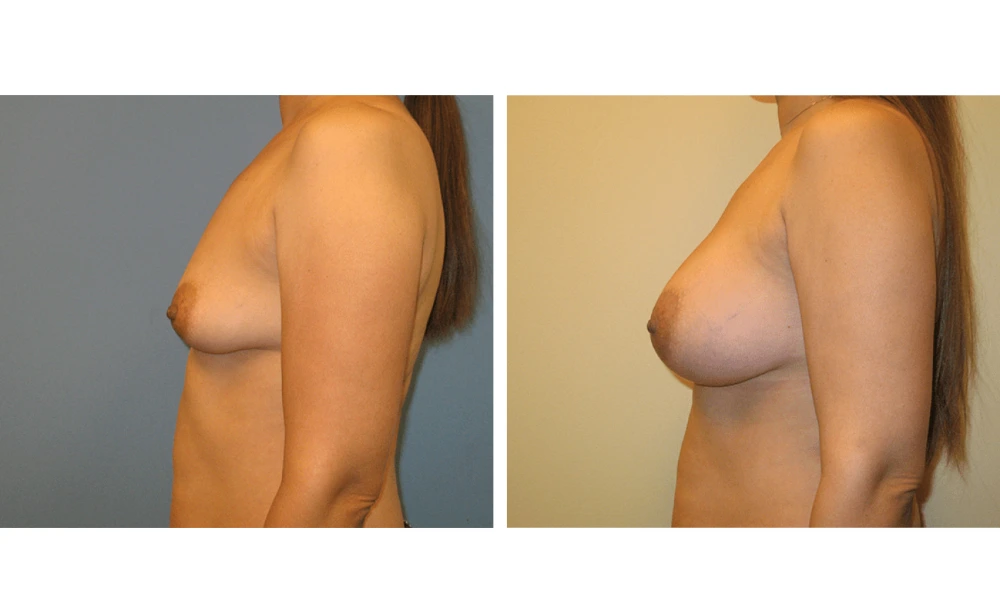 Breast augmentation Case 16 before and after, side profile showing natural-looking results