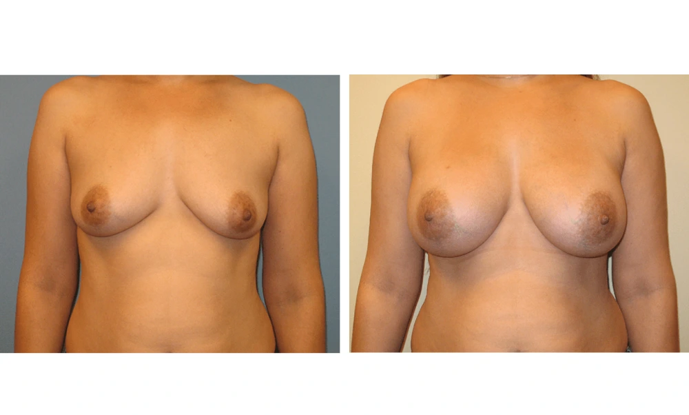 Breast augmentation Case 16 before and after, front view comparison of increased fullness