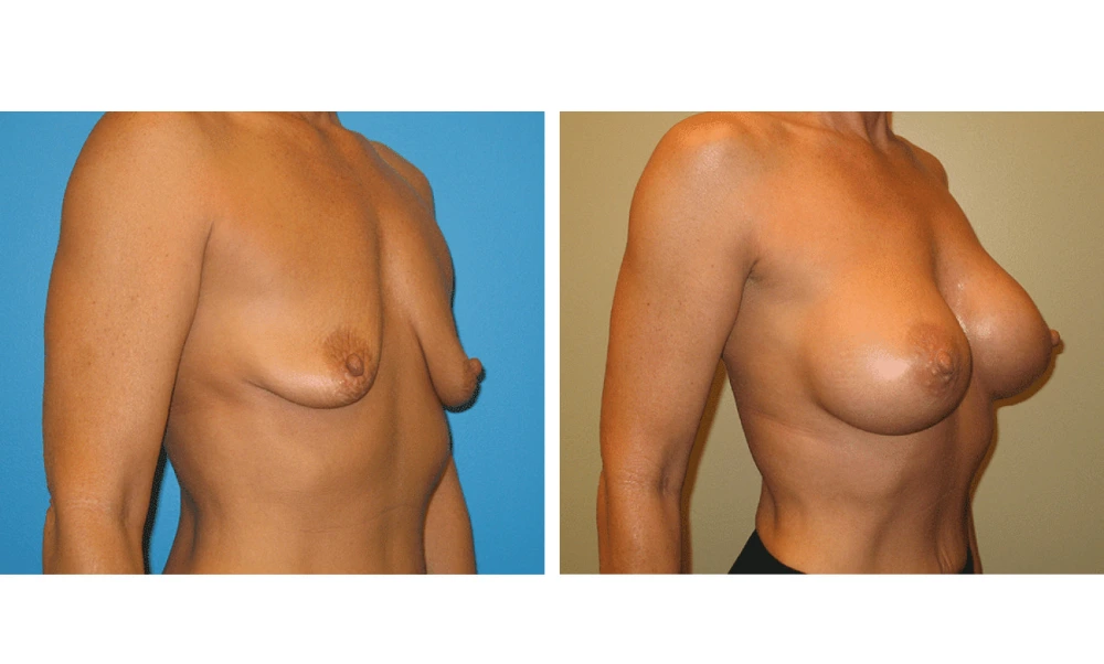 Breast augmentation before and after, three-quarter view displaying enhanced volume