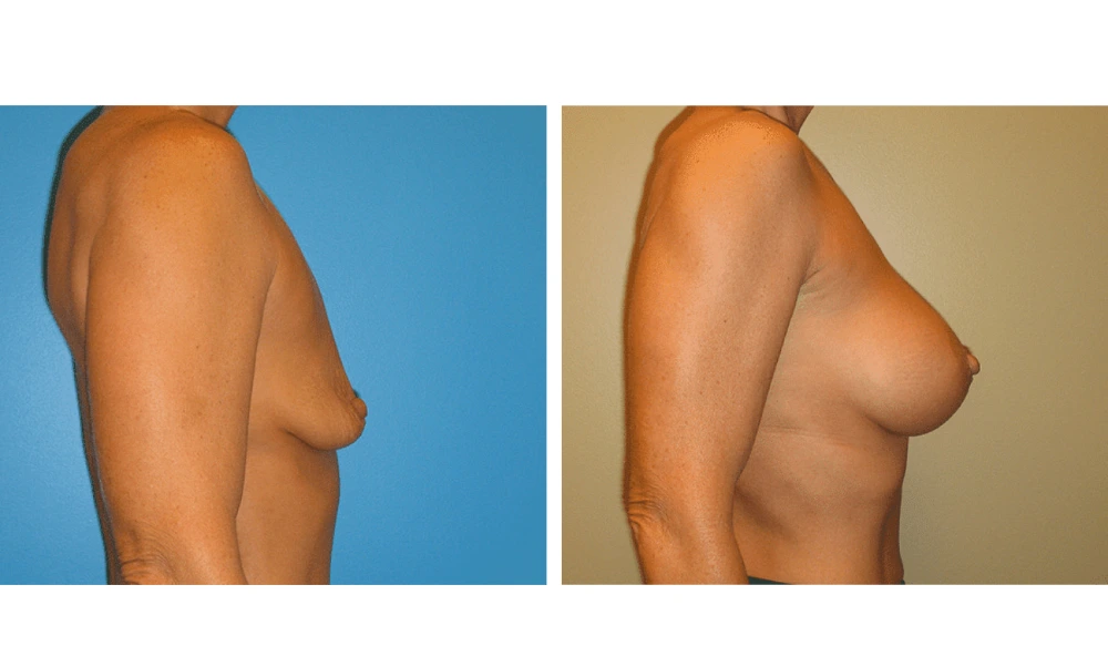 Breast augmentation before and after, side profile showing improved projection and shape
