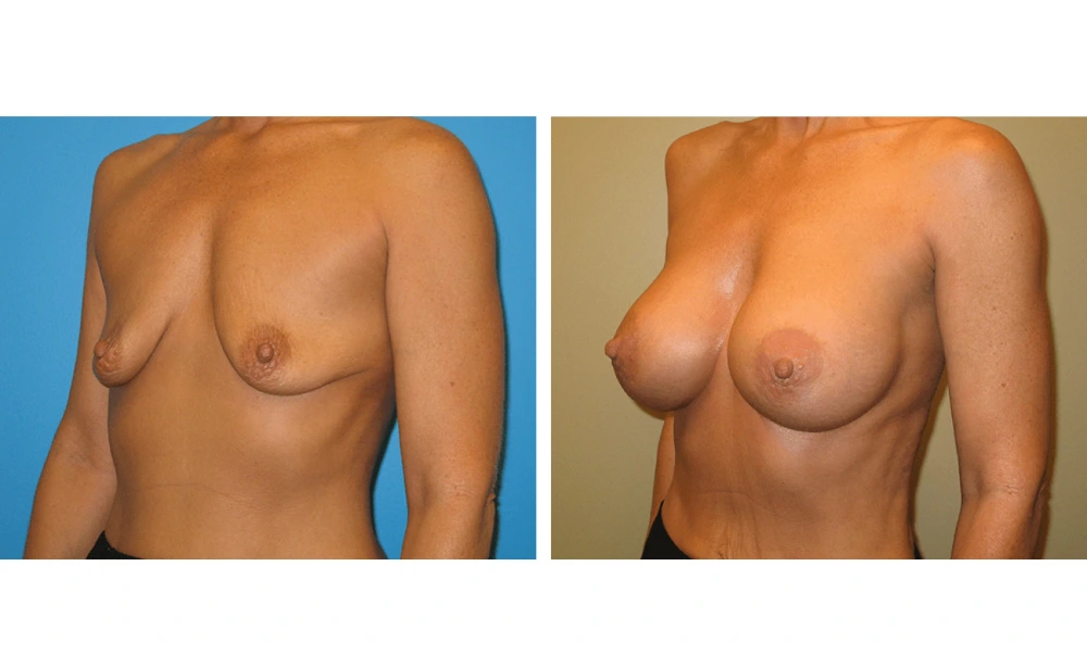 Breast augmentation before and after, oblique view showing enhanced shape and fullness